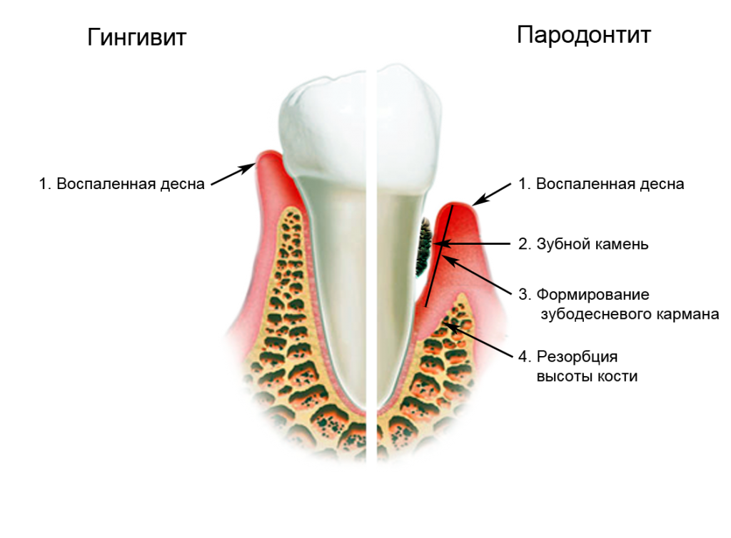 пародонтит
