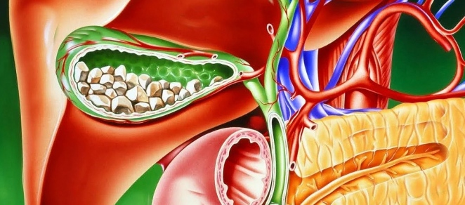 лікування жовчної коліки