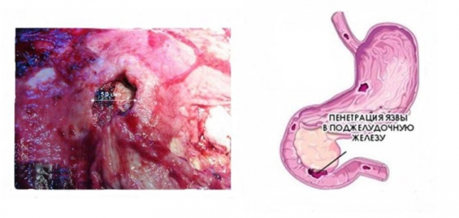 пенетрація виразки шлунка