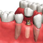 Зубные импланты. Что нужно знать и куда обратиться за помощью.