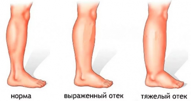 Почему сильно отекают ноги в жару и как этого избежать