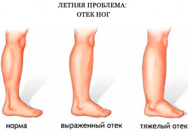 Почему сильно отекают ноги в жару и как этого избежать