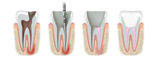 Що робити коли болить нерв зуба?