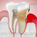 Що робити коли болить нерв зуба?