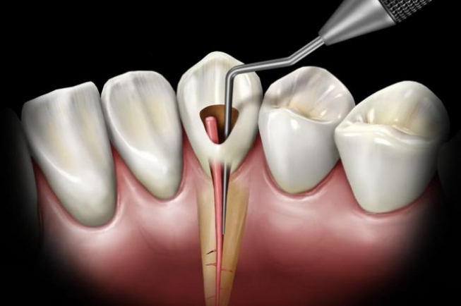 Що робити коли болить нерв зуба?