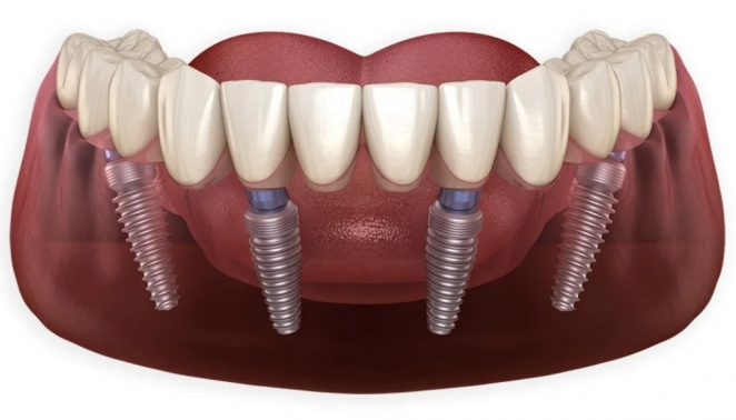 Основные достоинства протезирования зубов all-on-4